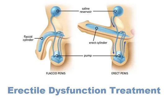 Erectile Dysfunction Surgery in India Cost Hospitals Doctor